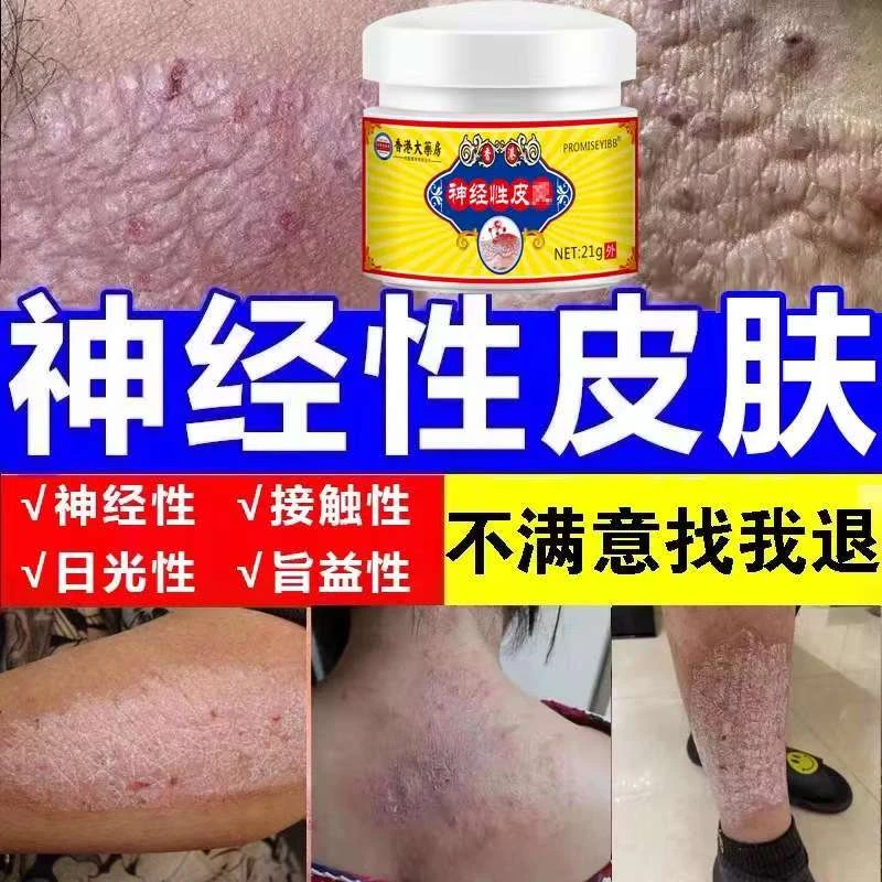 神经性皮肤止痒膏顽固皮手足脖子小腿湿痒抑菌乳膏特效修复克星
