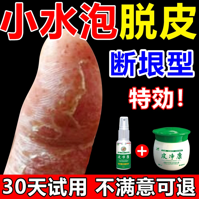 手指痒手上起水泡很痒止痒膏脱皮干裂手掌克星抑菌喷雾剂专用正品