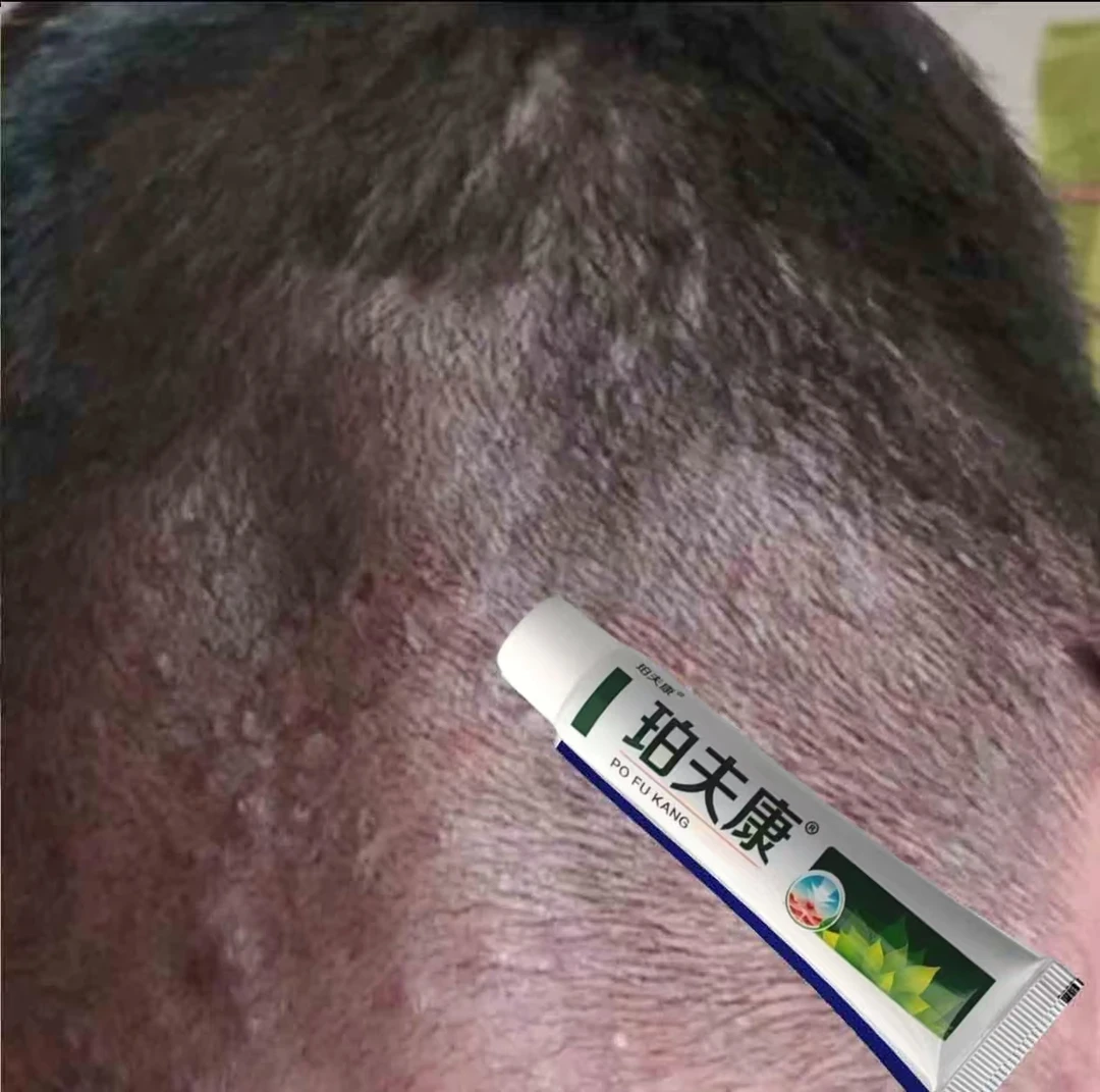 头皮毛囊怎么治疗头皮结痂乳膏头皮止痒抑菌专用毛囊红疙哒草乳膏
