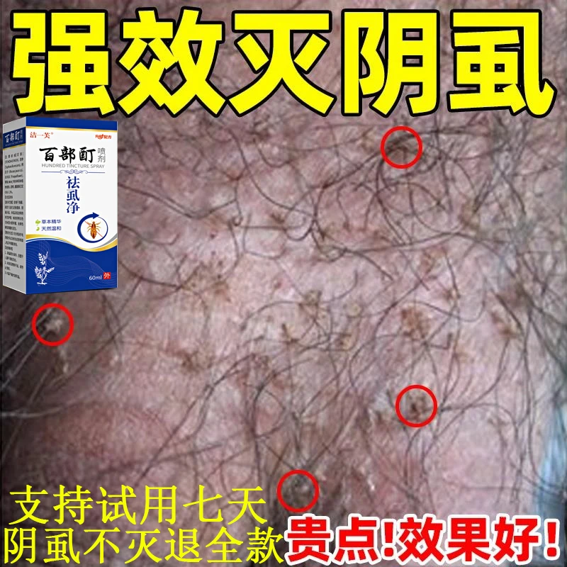百部酊去虱净成人私处男女通用阴虱源头哪里来的彻底消灭阴虱专用