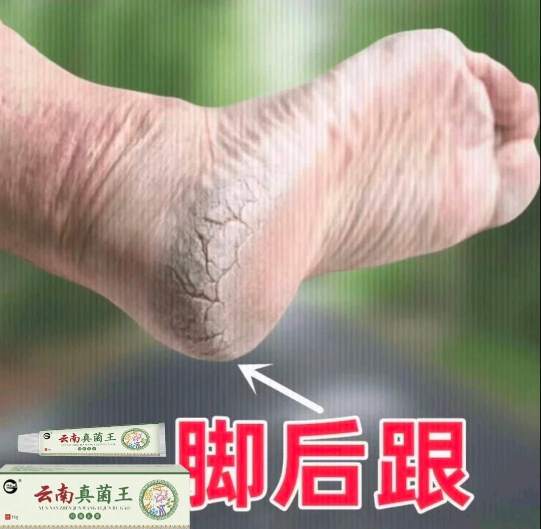 云南真菌王脚后跟开裂专用膏防裂膏手足干裂修复膏保湿粗糙嫩滑