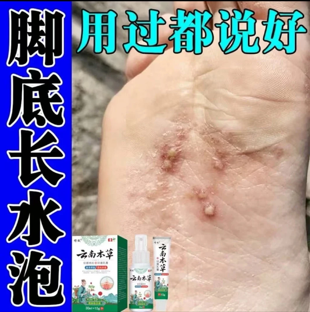 脚底脚上起小水痒泡脱皮真菌王脚臭气止痒抑菌软膏特效神器克星