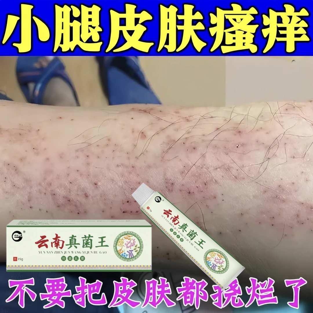 小腿皮肤痒腿上起红疙瘩痒长红点老年人皮肤瘙痒止痒抑菌乳膏