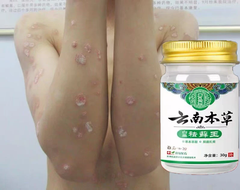 皮藓清牛皮鲜银屑手足鲜反复发体股鲜皮肤骚痒皮肤止痒膏