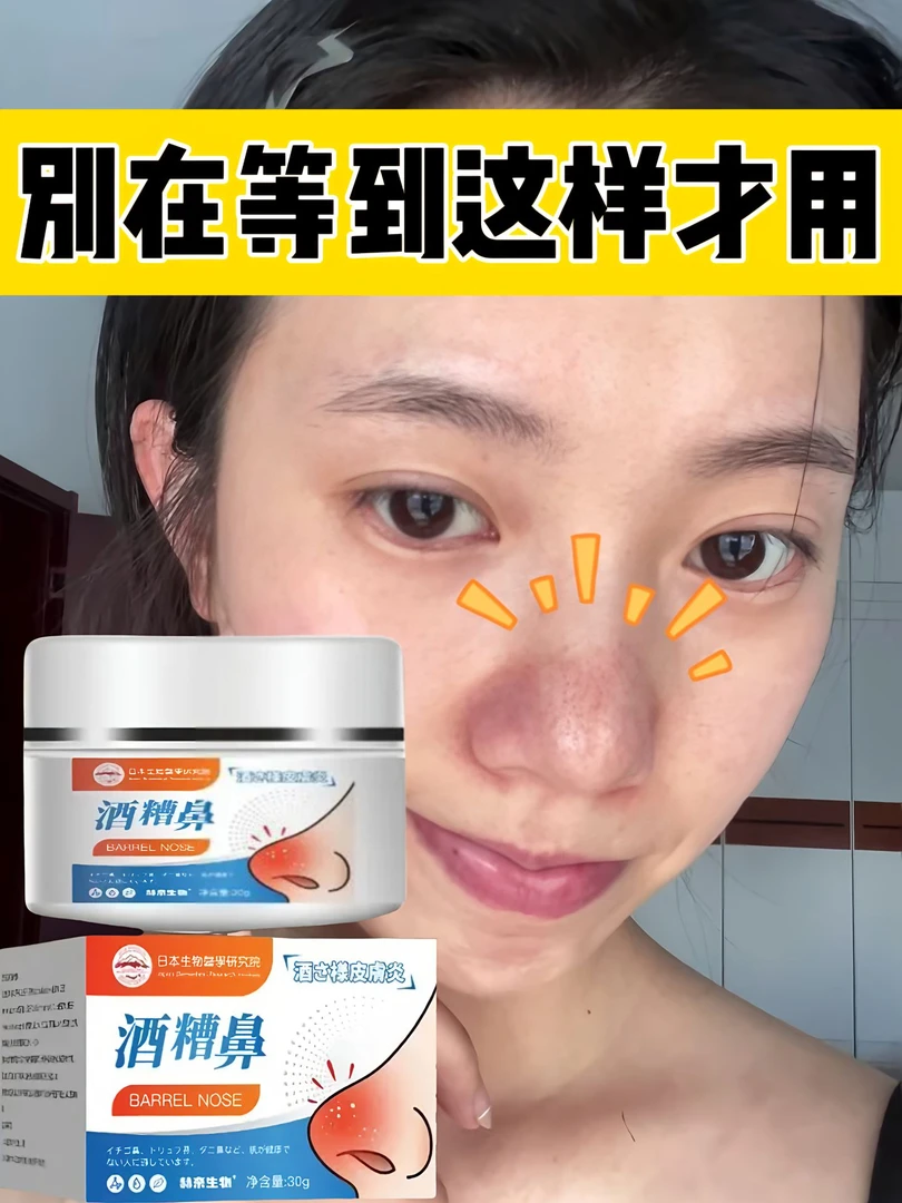 酒渣鼻红鼻子鼻头草莓大鼻子