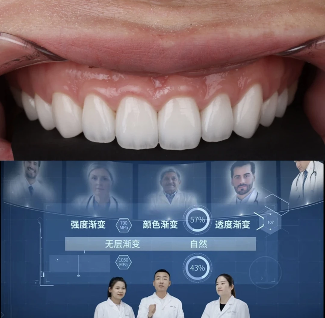 超薄全瓷美牙贴片咨询客服享专业服务
