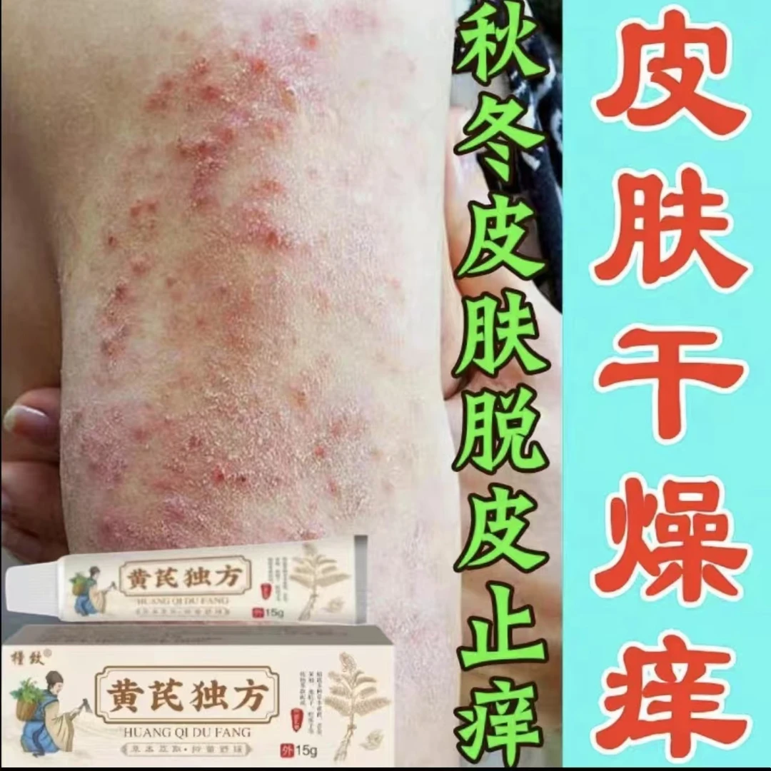 《天天绕不如试一次》黄芪独方乳膏全身各种痒止痒快克皮肤止痒乳膏