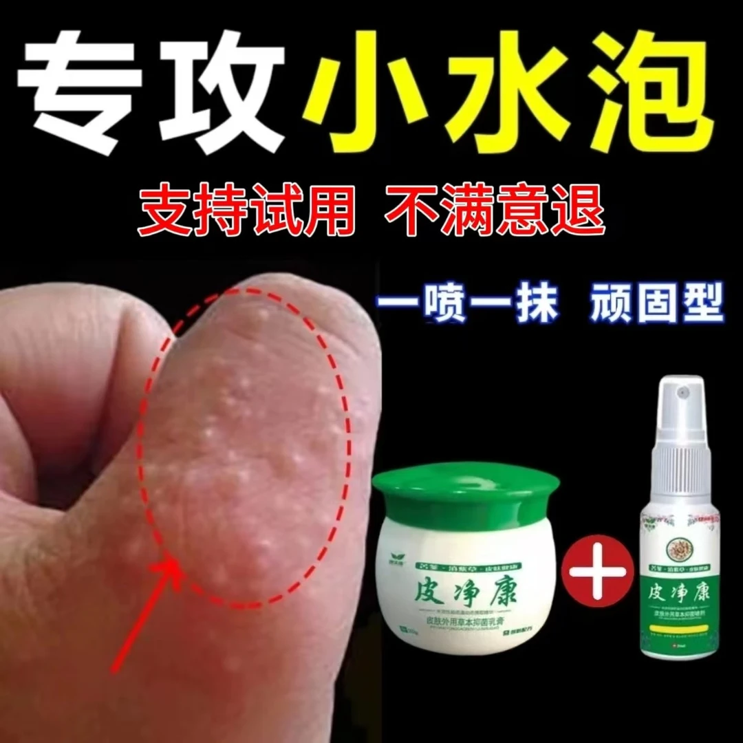 手上起小水泡很痒止痒膏汗脱皮泡抑菌乳膏手指手泡专用特效喷剂