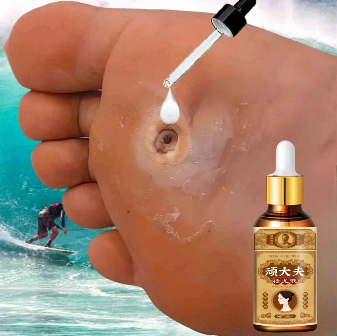 脚底鸡茧肉刺走路疼脚钉去除液脚底脚垫老茧去除神器修护软化液r