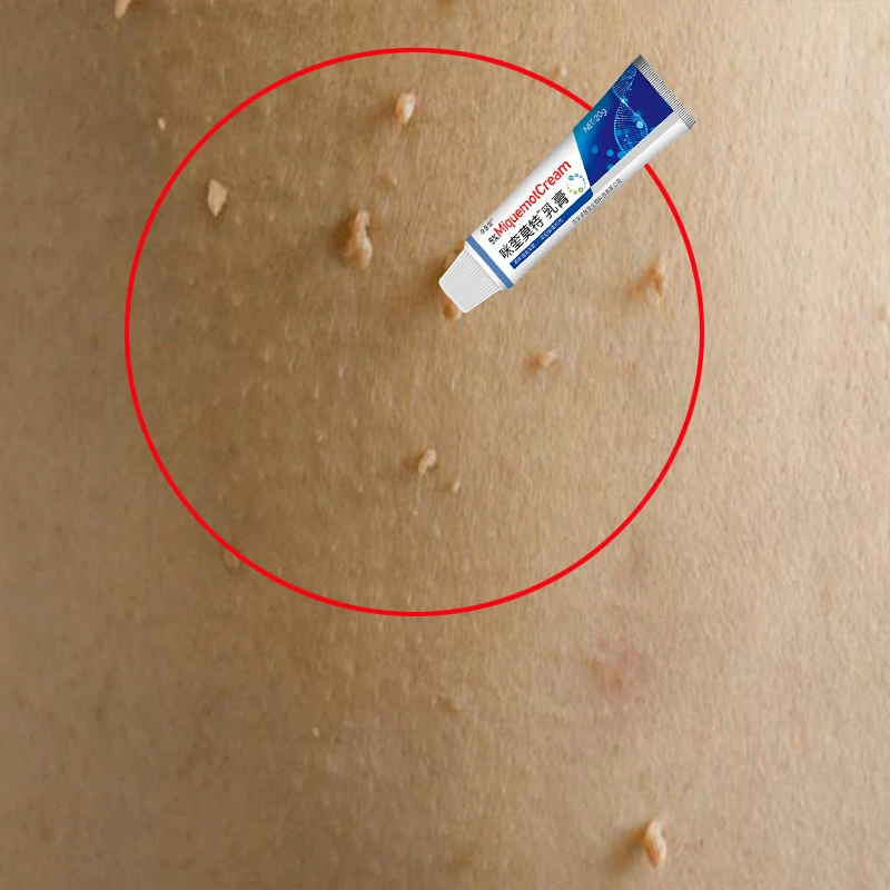 手背皮肤表面扁平圆形小疙瘩肉粒肉钉手足咪喹抑菌软膏