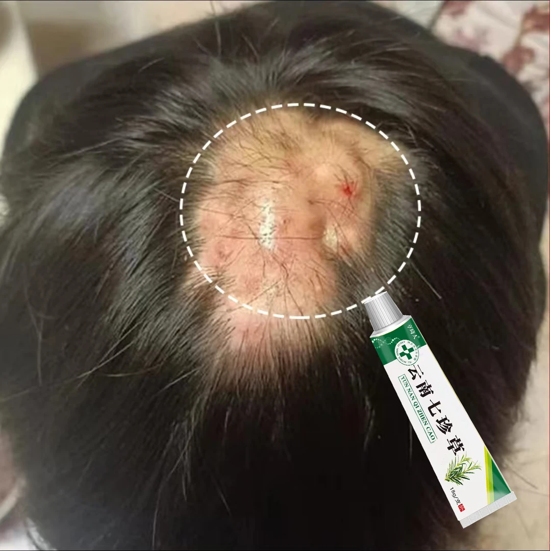 头皮毛囊起小红疙瘩脓包头屑长前胸后背毛囊痘止痒外用涂抹膏
