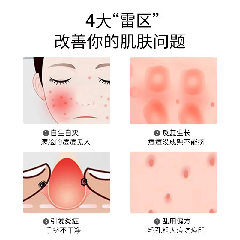 一次性粉刺针闭口暗疮挤痘痘美容院四件套针黑头针排针套装