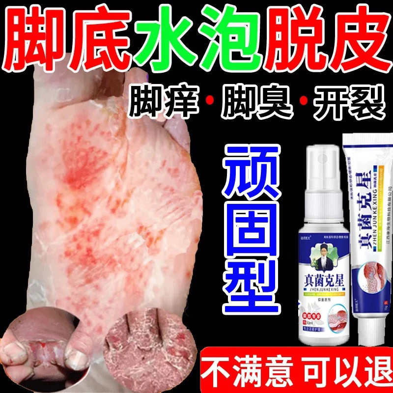 真菌王脚痒臭抑菌喷雾剂止痒神器干裂脱皮汗脚起水泡脚趾缝痒克星