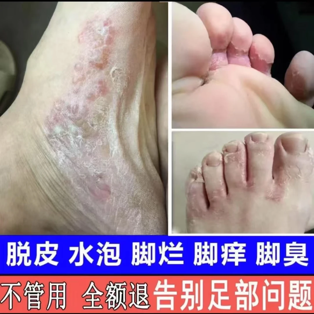 真菌王去脚臭脱皮开裂起水泡止痒气脚趾缝烂修复专用克星本草抑菌
