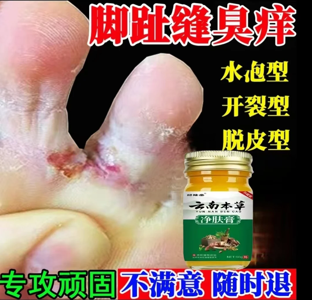 脚底脚上起小水泡又痒又脱皮脚臭气止痒真菌感染抑菌特效克星神器