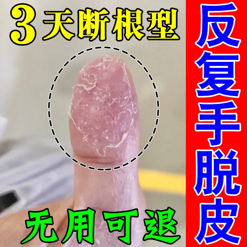 手指头蜕皮开裂粗糙手指缝痒起皮手发红脚后跟干裂修复膏