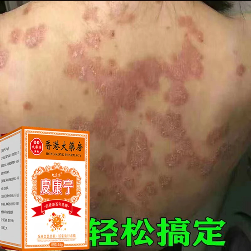 【香港皮康宁】牛皮肤银屑膏头藓顽固手足股止痒大腿内侧痒全身可用