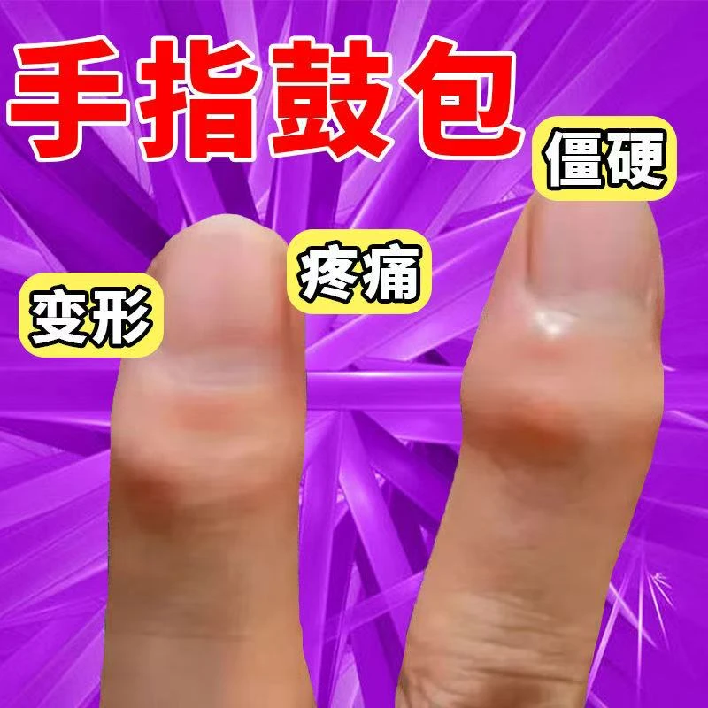 手指关节粗大疼变形肿大鼓包凸起骨节僵硬草本专用涂抹膏
