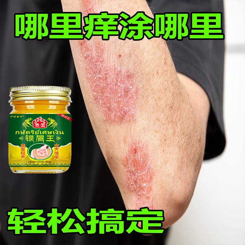 【泰国秘方】牛皮头藓银屑膏顽固手肤止痒大腿内侧全身可用止痒膏