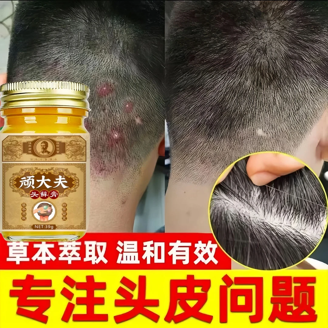 头藓专用头藓膏正品头皮痘痘脓包红疹皮肤瘙痒头藓真菌感染止痒膏