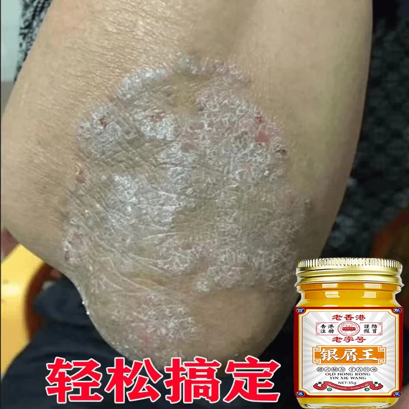 【香港银屑王】皮肤止痒牛抑菌草本温和外用止痒膏