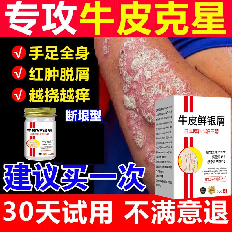 【卡泊三淳】全身牛皮廯/银屑藓头藓体藓皮焱湿诊止痒膏草本外用