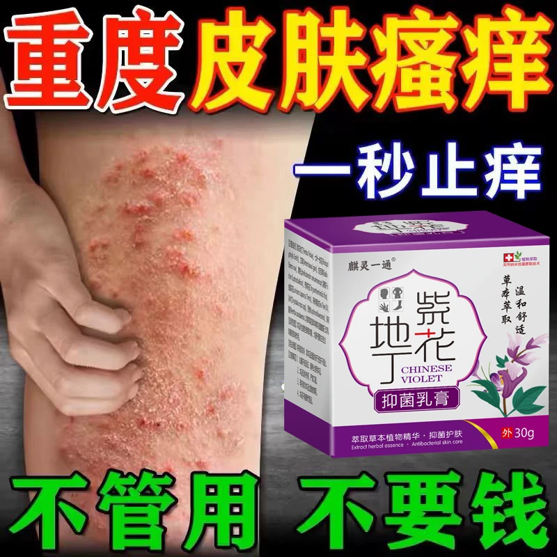 紫花地丁止痒膏牛皮廯顽固手足体股廯红点止痒大腿内侧痒外用乳膏