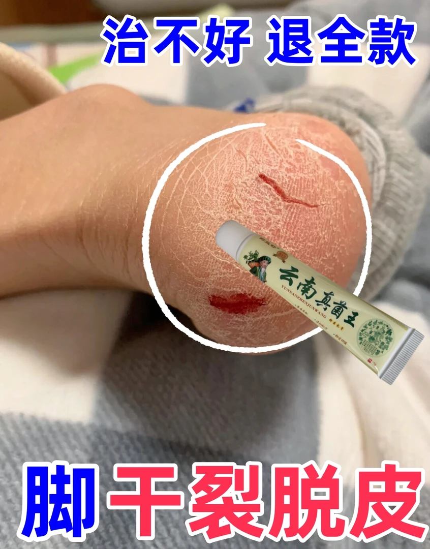 云南真菌王脚起皮脚脱皮修复膏脚后跟开裂皲裂防裂止痒膏