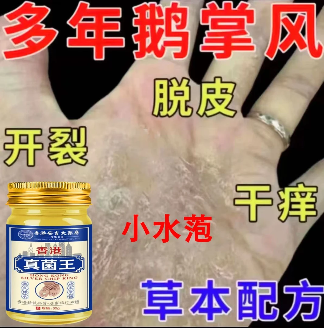 手指长小水萢手部痒手指开裂手指脱皮专用手上起汗泡抑菌专用软膏