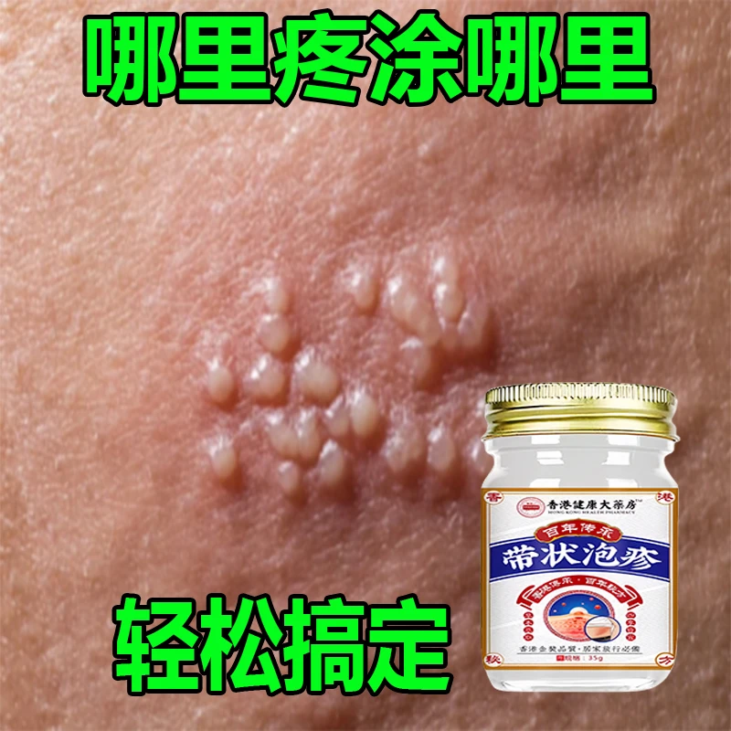 带状泡疹后遗神经痛蛇盘疮膏蛇盘清宝带状疱疹后遗症神经痛特效药
