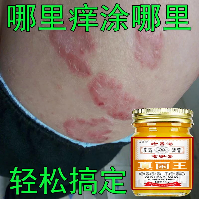 【香港真菌王】牛皮肤银屑膏头藓顽固手足止痒大腿内侧痒全身可用