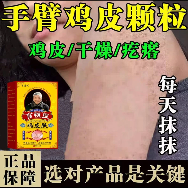 胳膊腿上鸡皮疙瘩毛囊堵黑点痘痘手臂密集小颗粒腿上干燥粗糙乳膏