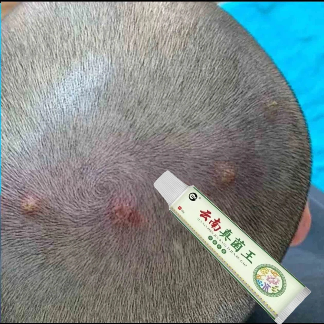 头皮毛囊起小红疙瘩脓包头屑长前胸后背毛囊痘止痒萃取外用涂抹膏