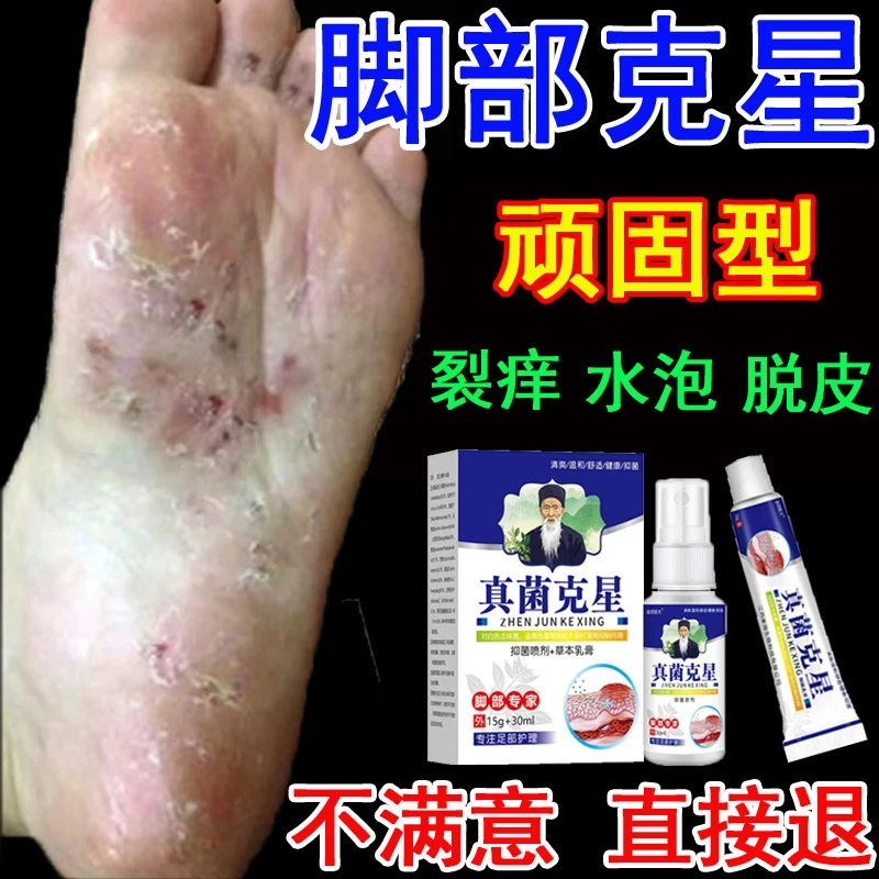 脚真菌水泡专用抑菌止痒膏脚臭气干裂脱皮汗脚趾缝痒喷剂克星套装