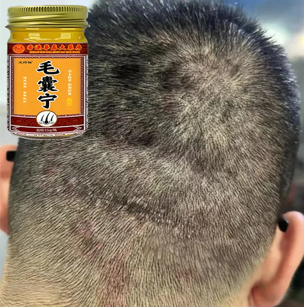 头皮头痒头上长小红疙瘩头上长痘痘起干皮头上毛囊严深层抑菌膏