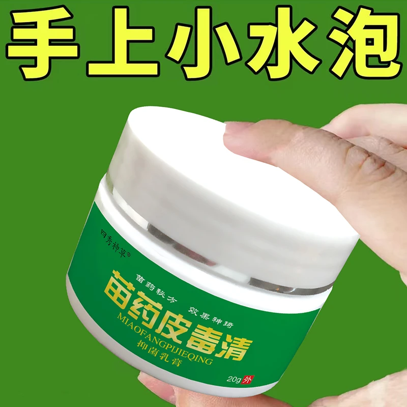 手上长小手痒手指缝开裂手指止痒脱皮手足干裂手足起疙瘩抑菌软膏