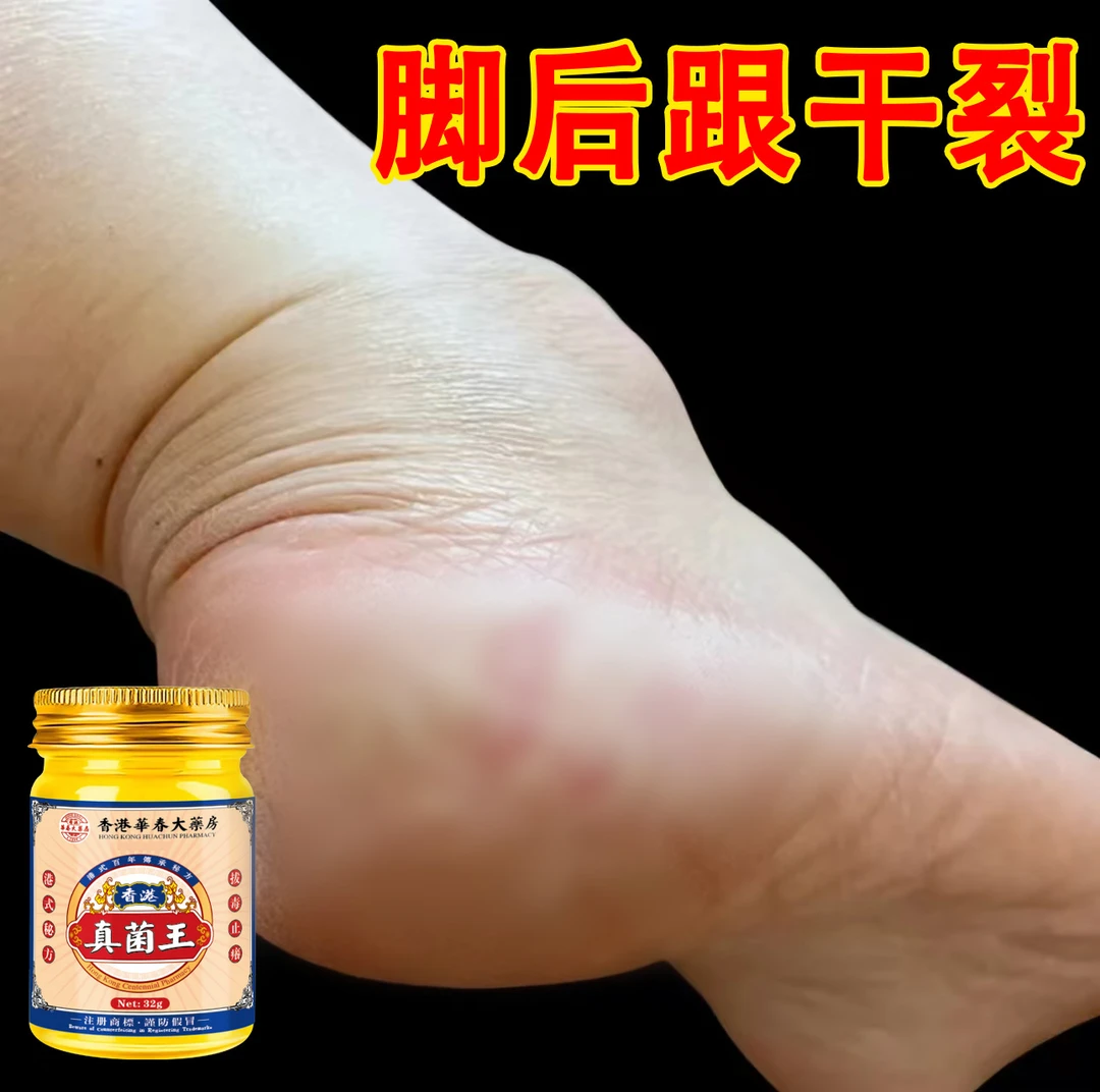 真菌王脚后跟开裂季节性神器脱皮膏手足干裂痒真菌感染抑菌止痒膏