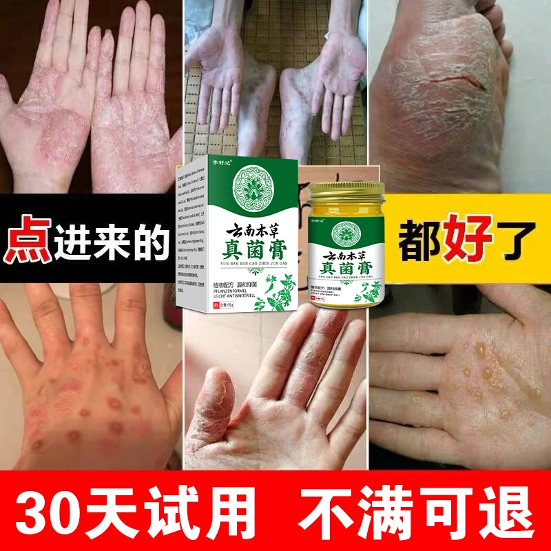【手好痒脱皮膏】干裂脱皮手痒手裂手足霜手足软膏脚干抑菌软膏