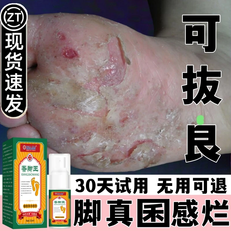 香港大药房正品脚痒有臭味脚脱皮喷剂脚臭起泡泡快速止痒抑菌乳膏