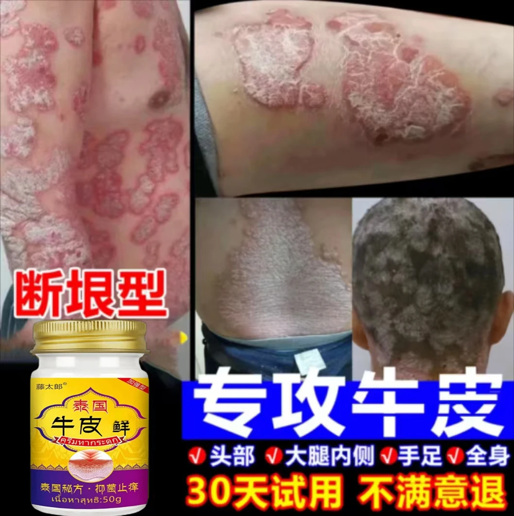 【牛皮廯克星】全身红点痒皮肤止痒去顽固根手足体股廯正品止痒乳膏
