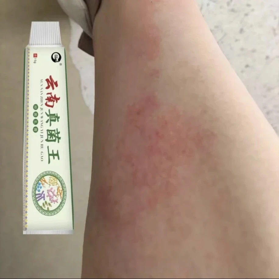 云南真菌王小腿上皮肤干燥瘙痒抑菌特效止痒膏腿部皮肤起红疙瘩