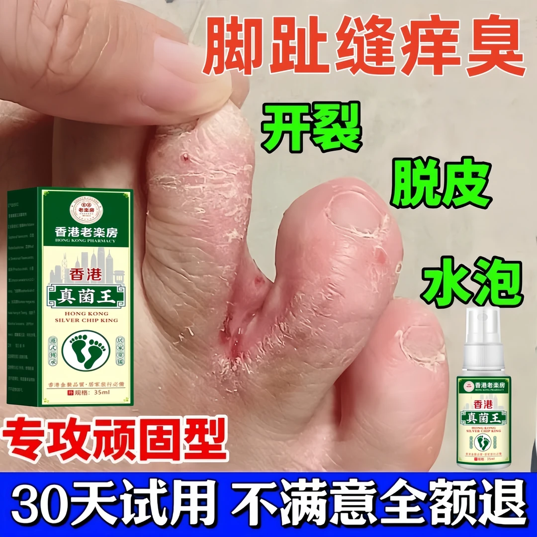 【官方正品】香港真菌王脚臭脚痒脱皮植物萃取外用皮肤抑菌止痒喷剂