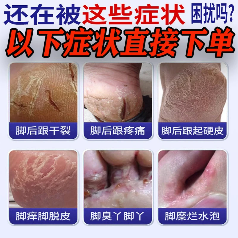 治疗足癣脚气专用药顽固脚气脚臭止痒药脚趾缝痒脚丫水泡脱皮裂口治疗修复足部外用药马应龙水杨酸软膏5%*10g