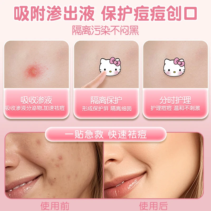 AUSLKA三丽鸥Hellokitty痘痘贴kt凯蒂猫可爱不刺激水胶体轻薄透气