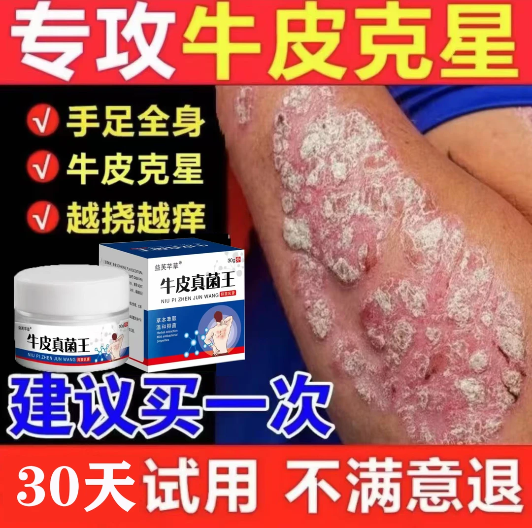 【牛皮真菌王】全身牛皮廯/银屑藓头藓体藓皮焱湿诊止痒膏草本抑菌