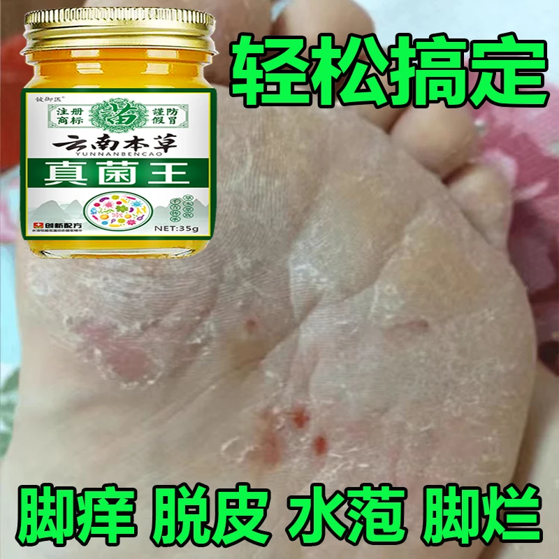 正品真菌王脚臭脚痒脱皮起水萢脚后跟干裂趾缝痒膝肘贴草本抑菌膏