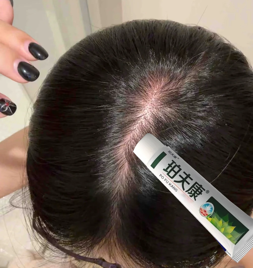 头皮细菌性毛囊疙瘩后背痘痘症状专用头皮干痒小脓包特效治疗乳膏