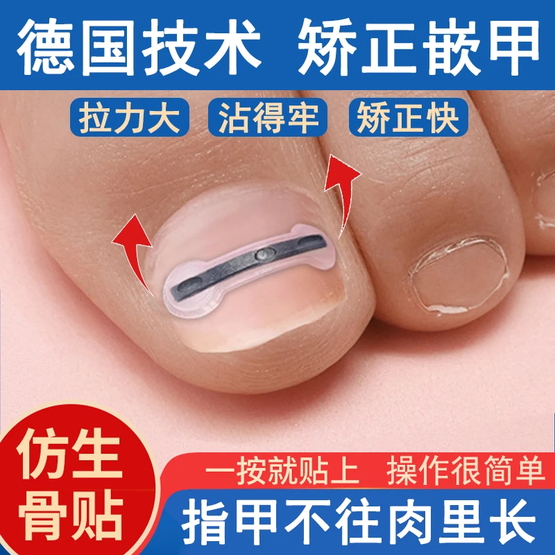 正甲贴片钛合金弹甲沟嵌矫正器脚趾甲盖内嵌神器专用指甲长肉里