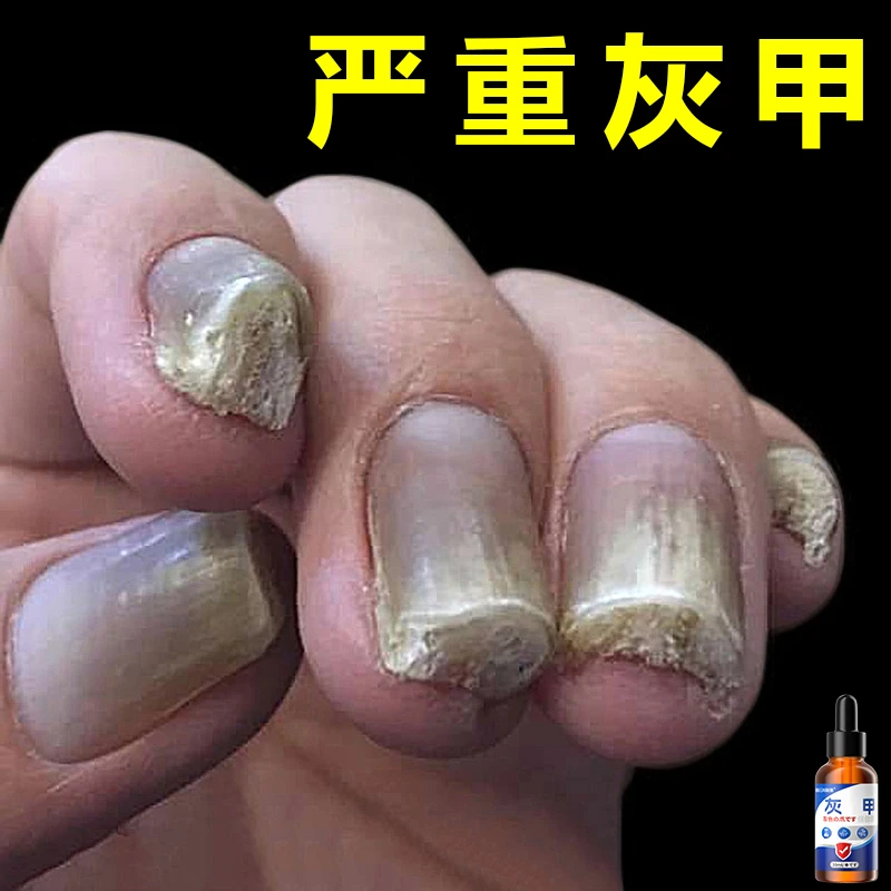 【强效装】正品草本植物严重指甲变厚抑菌指甲发黑坏甲净指甲乳液S