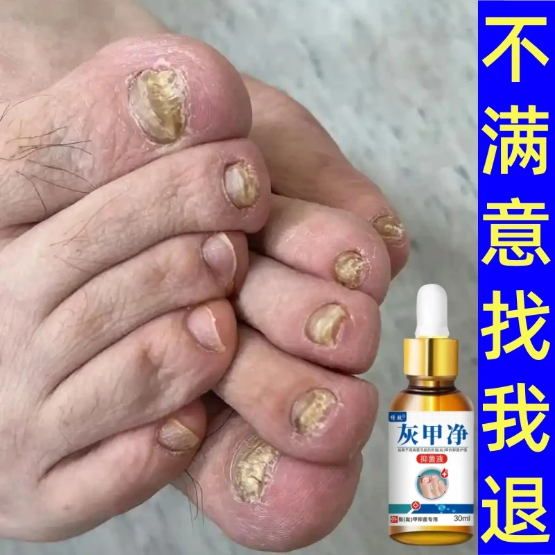 灰趾指甲灰脚趾甲液脚指甲精华液岬增厚凤仙花手脚甲护甲抑菌液